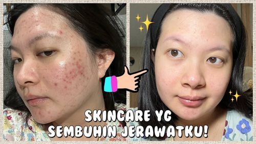 Skincare yang sembuhin jerawatku selama hamil! ✨ (Whitelab & Npure)